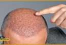 Hair Transplant Treatment