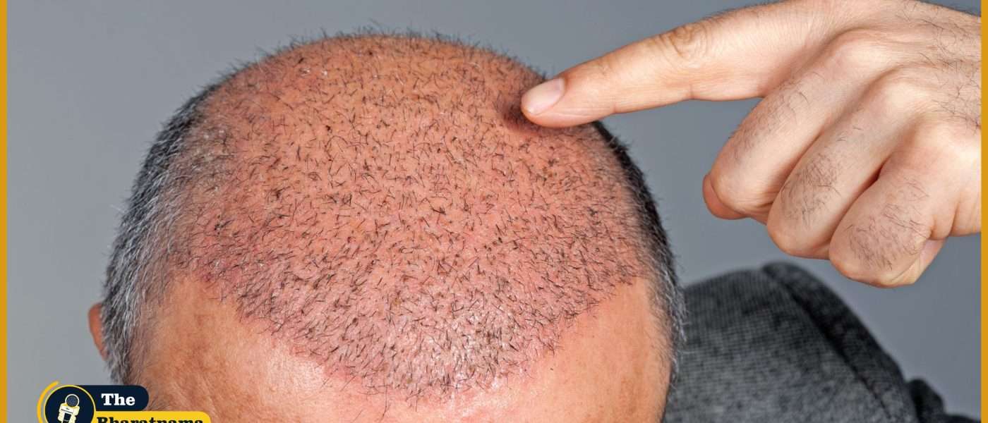 Hair Transplant Treatment