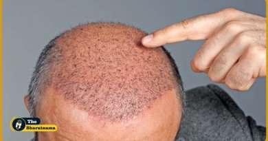 Hair Transplant Treatment