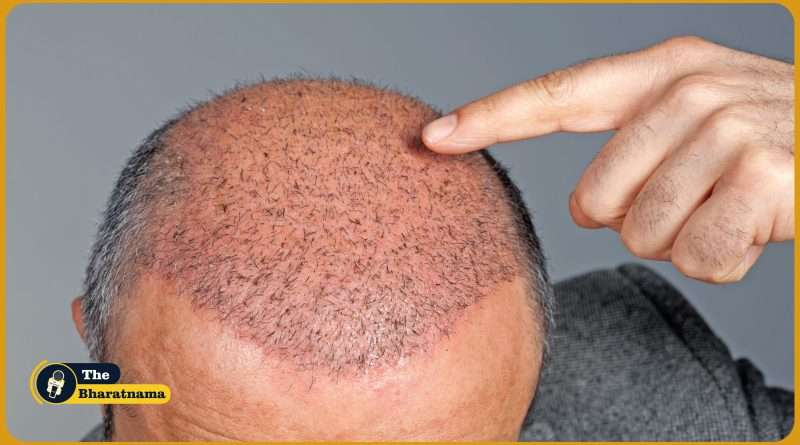 Hair Transplant Treatment